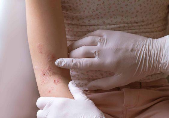 How to deal with dermatitis around the wound?