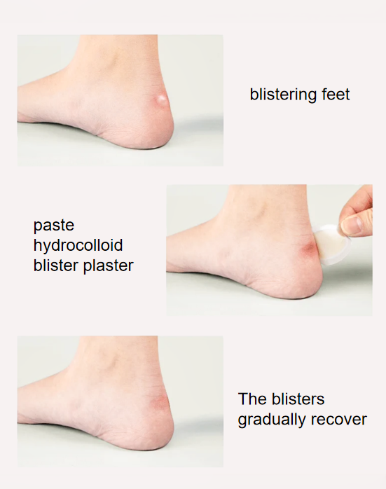 blister plaster