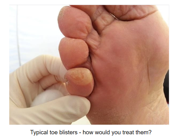 typical toe blisters