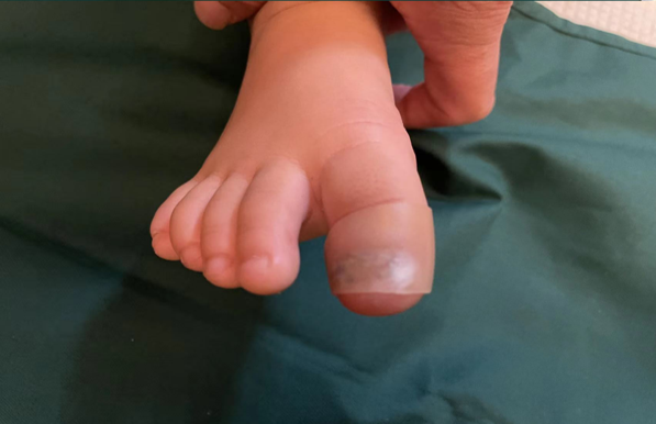 Injured toenails in children