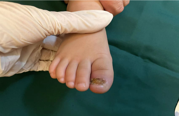 Injured toenails in children