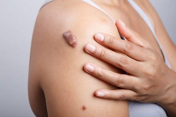 Do you know how to treat keloid scars?