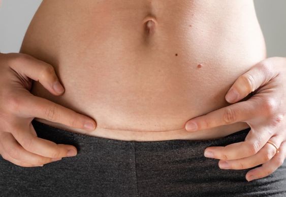 What is the cause of a lump at the cesarean section incision?