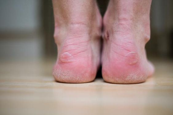 Weight-bearing heel injuries